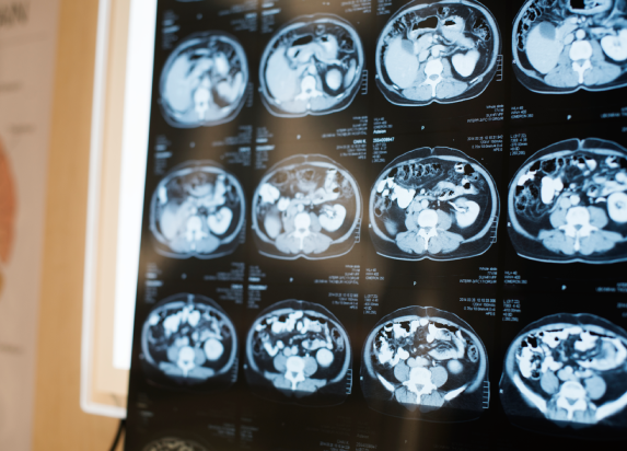Close-up view of abdominal CT scan images displayed on a medical imaging screen for diagnostic evaluation and healthcare analysis.Close-up view of abdominal CT scan images displayed on a medical imaging screen for diagnostic evaluation and healthcare analysis.