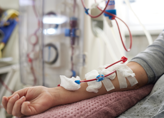 Patient receiving dialysis treatment with medical tubing attached to the arm in a hospital setting, highlighting nephrologist care for kidney health.