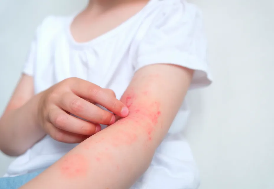 Child experiencing a skin allergy with a red, itchy rash on the arm.